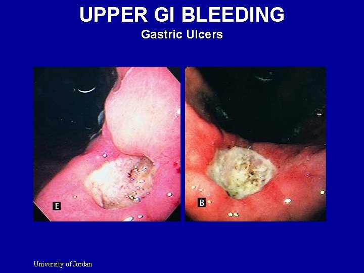 UPPER GI BLEEDING Gastric Ulcers University of Jordan 