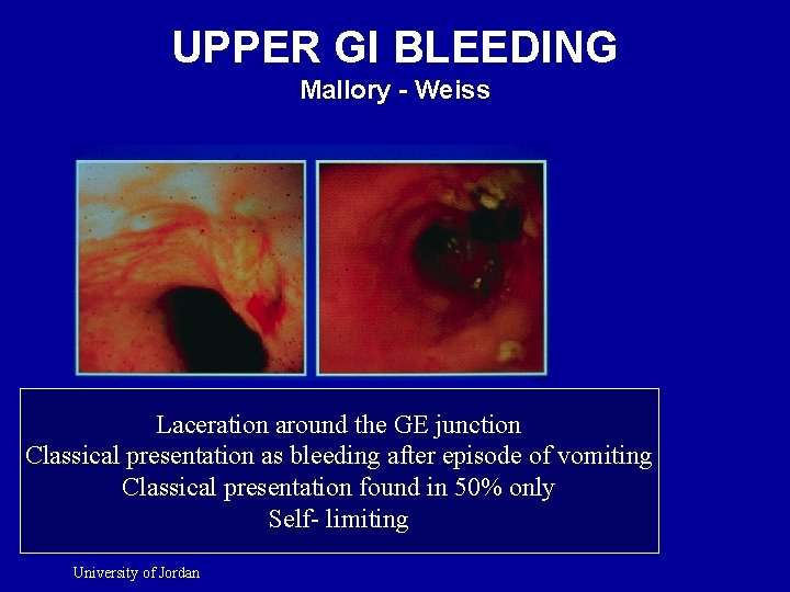 UPPER GI BLEEDING Mallory - Weiss Laceration around the GE junction Classical presentation as