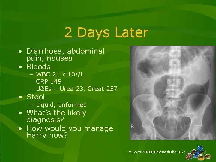 2 Days Later • Diarrhoea, abdominal pain, nausea • Bloods – WBC 21 x 2 Days Later • Diarrhoea, abdominal pain, nausea • Bloods – WBC 21 x