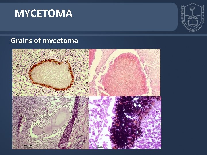 MYCETOMA Grains of mycetoma MYCETOMA Grains of mycetoma