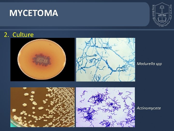MYCETOMA 2. Culture Madurella spp Actinomycete MYCETOMA 2. Culture Madurella spp Actinomycete