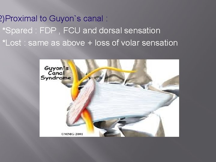 2)Proximal to Guyon`s canal : *Spared : FDP , FCU and dorsal sensation *Lost