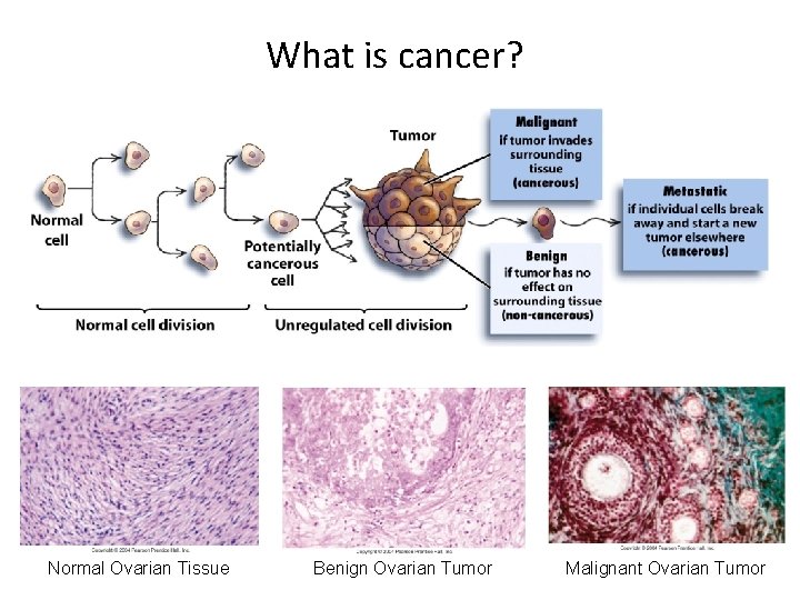 What is cancer? Normal Ovarian Tissue Benign Ovarian Tumor Malignant Ovarian Tumor 