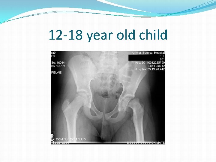 12 -18 year old child 