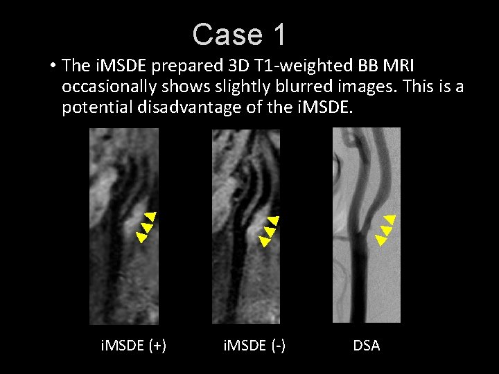 Case 1 • The i. MSDE prepared 3 D T 1 -weighted BB MRI