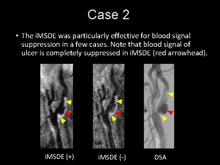 Case 2 • The i. MSDE was particularly effective for blood signal suppression in