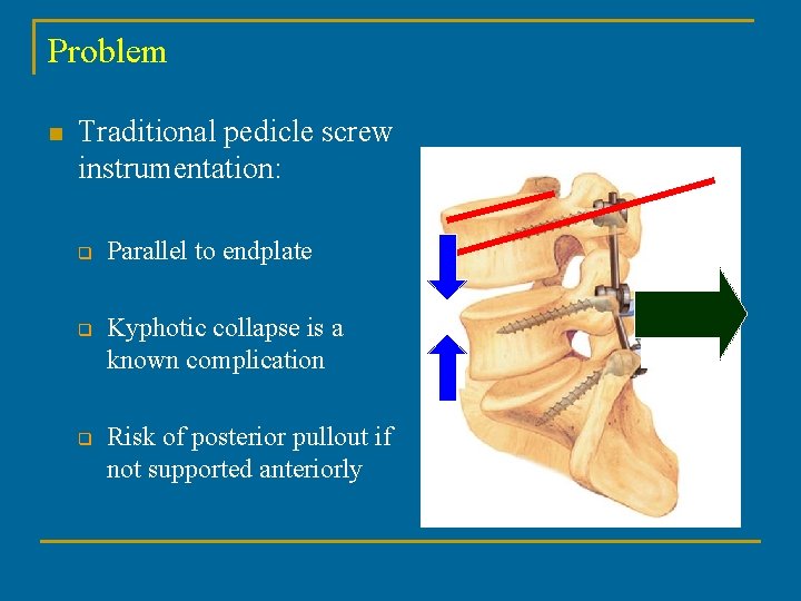 Problem n Traditional pedicle screw instrumentation: q q q Parallel to endplate Kyphotic collapse