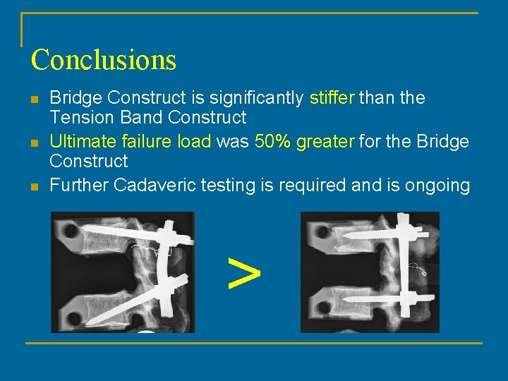 Conclusions n n n Bridge Construct is significantly stiffer than the Tension Band Construct