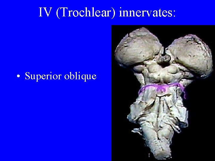 IV (Trochlear) innervates: • Superior oblique 