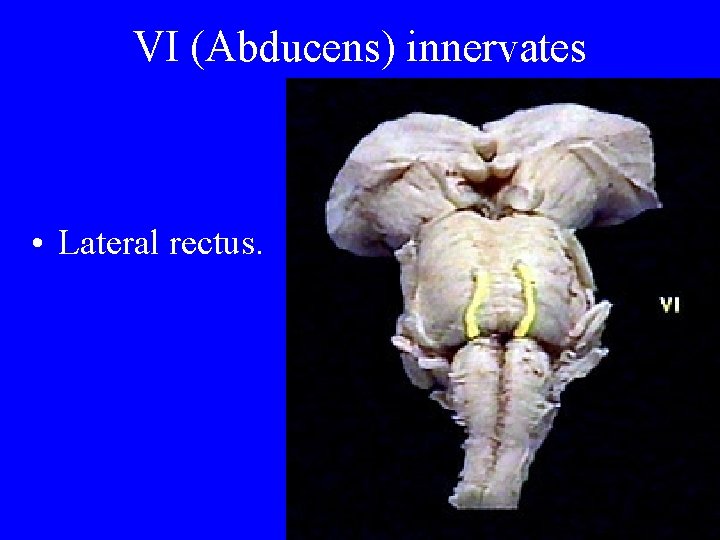 VI (Abducens) innervates • Lateral rectus. 
