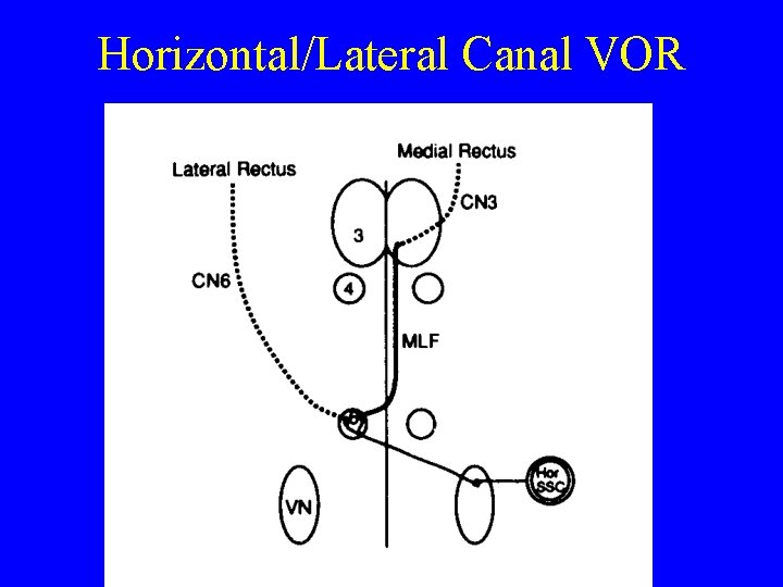 Horizontal/Lateral Canal VOR 