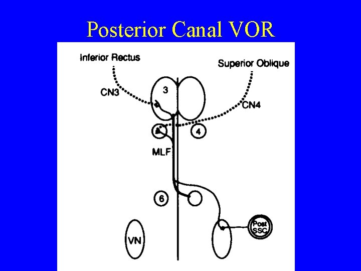 Posterior Canal VOR 