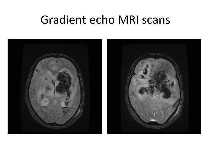 Gradient echo MRI scans 