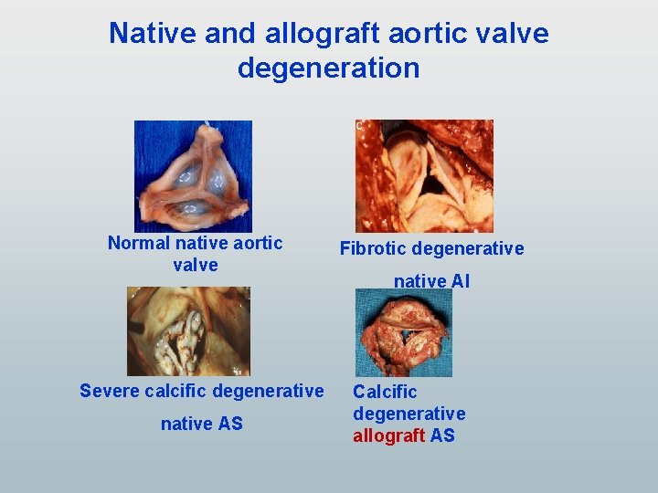 Native and allograft aortic valve degeneration Normal native aortic valve Severe calcific degenerative native Native and allograft aortic valve degeneration Normal native aortic valve Severe calcific degenerative native