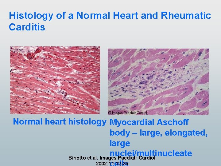 Histology of a Normal Heart and Rheumatic Carditis Normal heart histology Myocardial Aschoff body Histology of a Normal Heart and Rheumatic Carditis Normal heart histology Myocardial Aschoff body