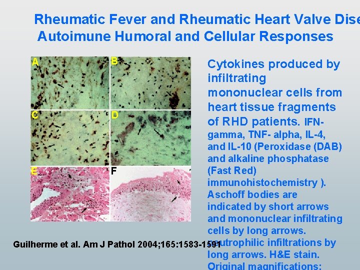 Rheumatic Fever and Rheumatic Heart Valve Dise Autoimune Humoral and Cellular Responses A B Rheumatic Fever and Rheumatic Heart Valve Dise Autoimune Humoral and Cellular Responses A B