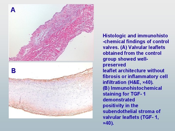 A B Histologic and immunohisto -chemical findings of control valves. (A) Valvular leaflets obtained A B Histologic and immunohisto -chemical findings of control valves. (A) Valvular leaflets obtained