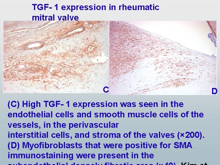TGF- 1 expression in rheumatic mitral valve C (C) High TGF- 1 expression was TGF- 1 expression in rheumatic mitral valve C (C) High TGF- 1 expression was