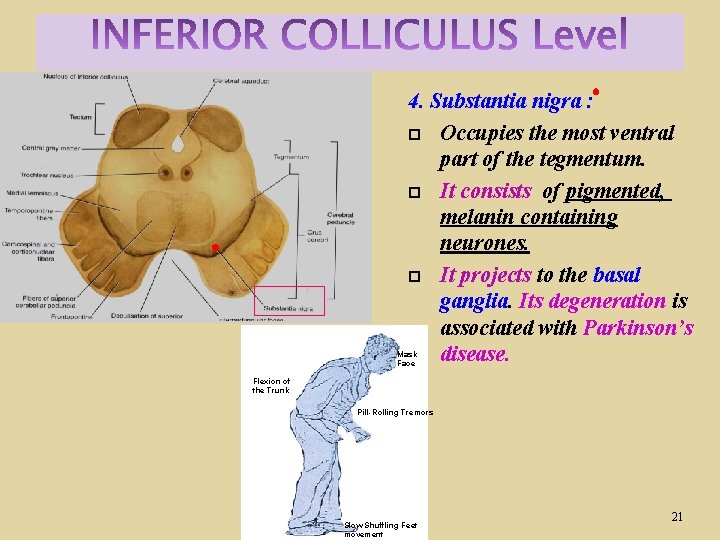 4. Substantia nigra : Occupies the most ventral part of the tegmentum. It consists