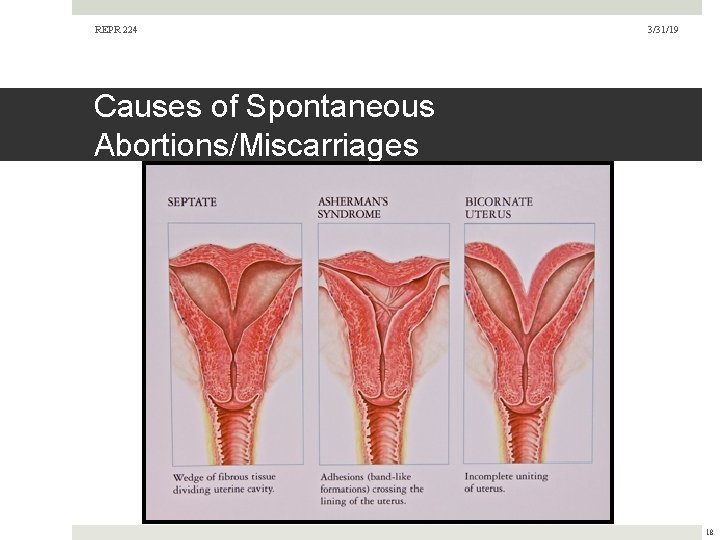 REPR 224 3/31/19 Causes of Spontaneous Abortions/Miscarriages 18  REPR 224 3/31/19 Causes of Spontaneous Abortions/Miscarriages 18