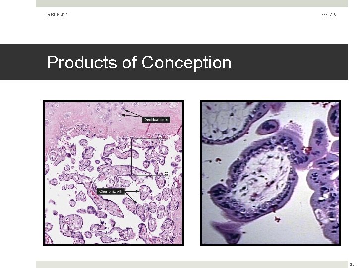 REPR 224 3/31/19 Products of Conception 21  REPR 224 3/31/19 Products of Conception 21