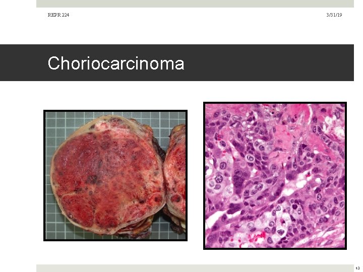 REPR 224 3/31/19 Choriocarcinoma 43  REPR 224 3/31/19 Choriocarcinoma 43