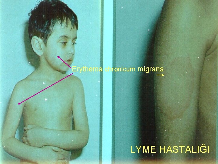 Erythema chronicum migrans LYME HASTALIĞI 