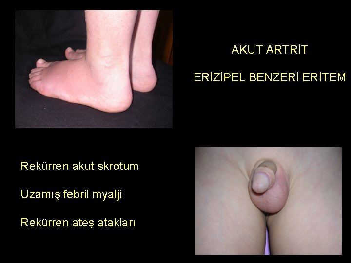 AKUT ARTRİT ERİZİPEL BENZERİ ERİTEM FMF Rekürren akut skrotum Uzamış febril myalji Rekürren ateş