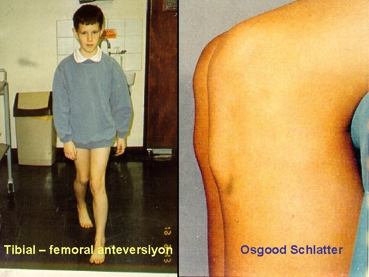 Tibial – femoral anteversiyon Osgood Schlatter 