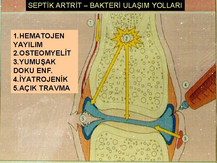 SEPTİK ARTRİT – BAKTERİ ULAŞIM YOLLARI 1. HEMATOJEN YAYILIM 2. OSTEOMYELİT 3. YUMUŞAK DOKU