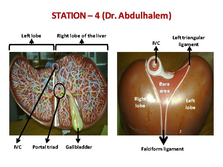 STATION – 4 (Dr. Abdulhalem) Left lobe Right lobe of the liver IVC Left
