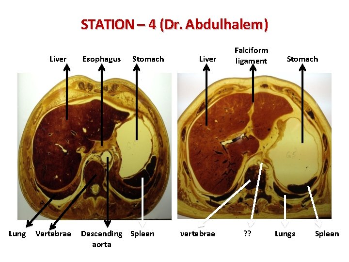 STATION – 4 (Dr. Abdulhalem) Liver Lung Vertebrae Esophagus Stomach Descending Spleen aorta Liver