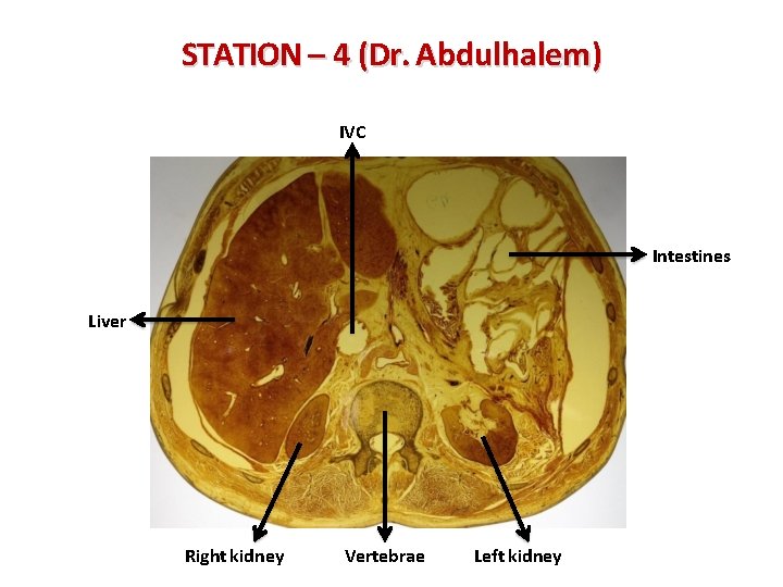 STATION – 4 (Dr. Abdulhalem) IVC Intestines Liver Right kidney Vertebrae Left kidney 