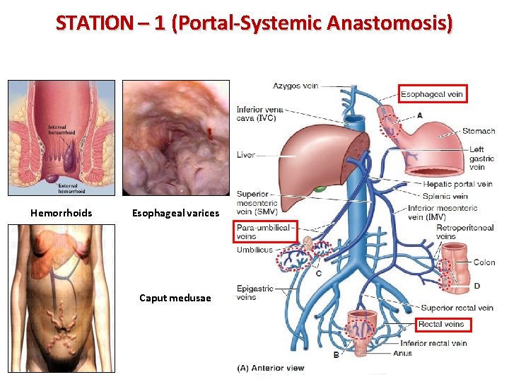 STATION – 1 (Portal-Systemic Anastomosis) Hemorrhoids Esophageal varices Caput medusae 