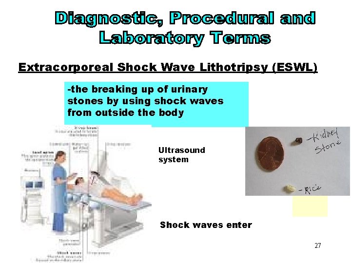ESWL Extracorporeal Shock Wave Lithotripsy (ESWL) -the breaking up of urinary stones by using
