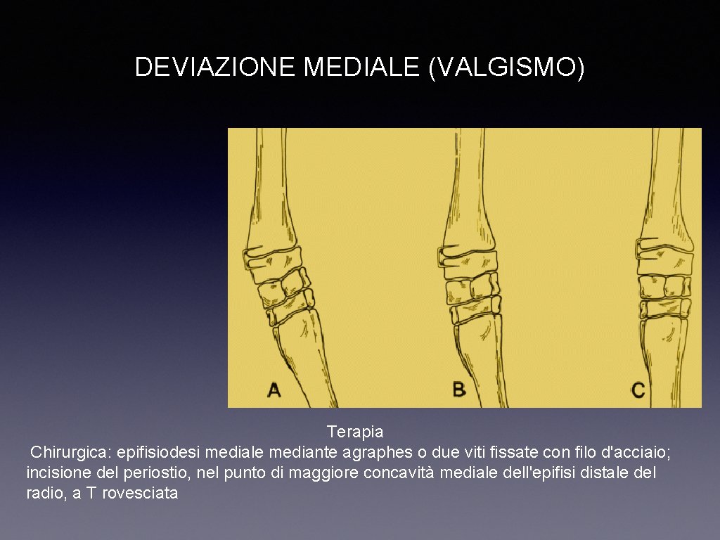 DEVIAZIONE MEDIALE (VALGISMO) Diagnosi Clinica e radiologica. Prognosi Favorevole. Terapia Chirurgica: epifisiodesi mediale mediante