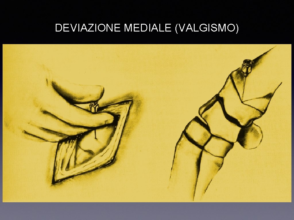 DEVIAZIONE MEDIALE (VALGISMO) 