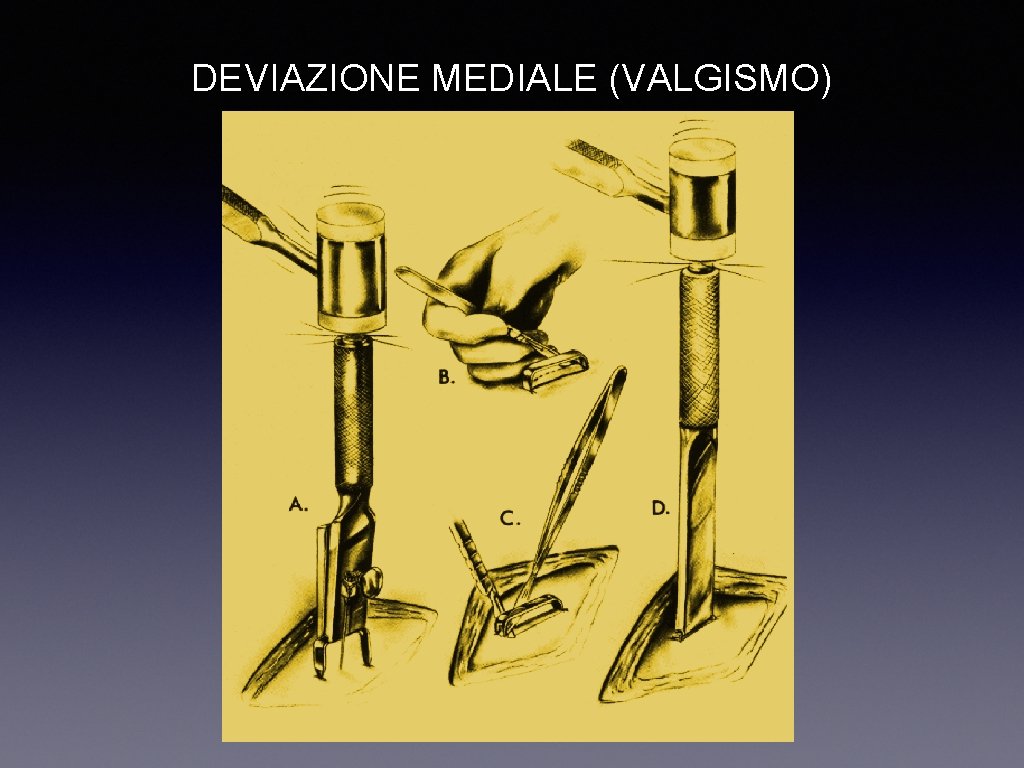 DEVIAZIONE MEDIALE (VALGISMO) 