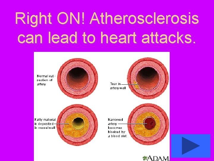 Right ON! Atherosclerosis can lead to heart attacks. 
