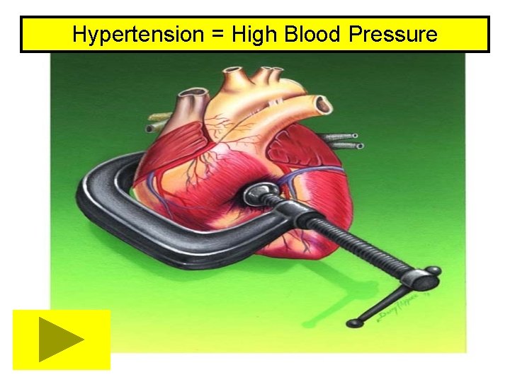 Hypertension = High Blood Pressure 