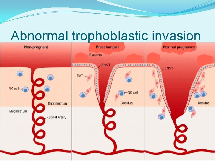 Abnormal trophoblastic invasion 