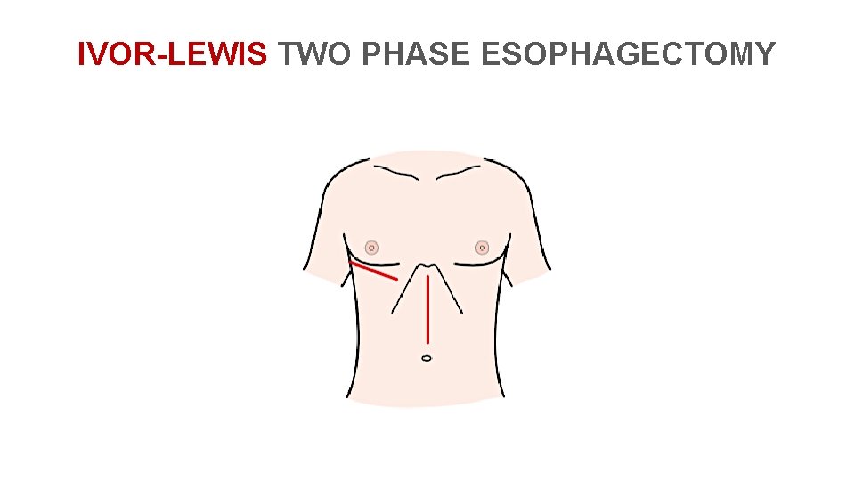 IVOR-LEWIS TWO PHASE ESOPHAGECTOMY 