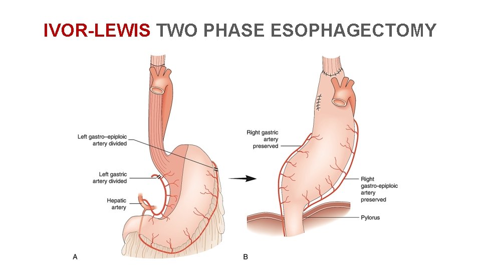 IVOR-LEWIS TWO PHASE ESOPHAGECTOMY 