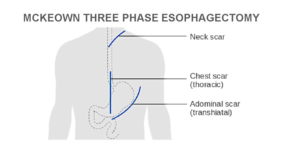 MCKEOWN THREE PHASE ESOPHAGECTOMY 