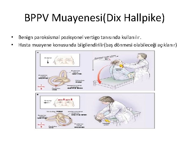 BPPV Muayenesi(Dix Hallpike) • Benign paroksismal pozisyonel vertigo tanısında kullanılır. • Hasta muayene konusunda