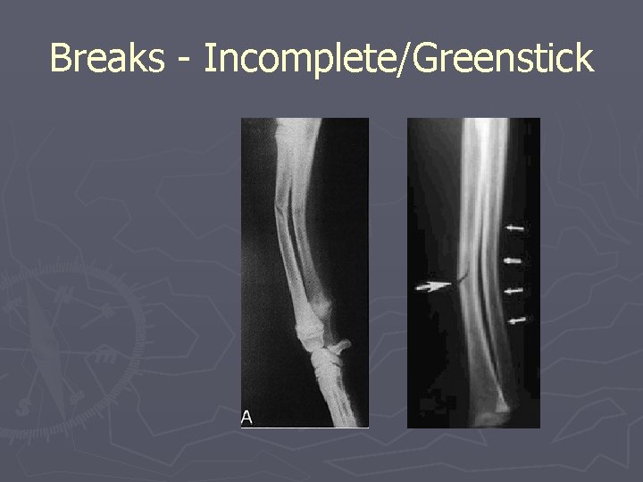 Breaks - Incomplete/Greenstick 