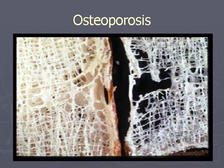 Osteoporosis 