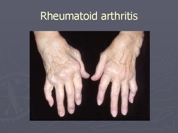 Rheumatoid arthritis 