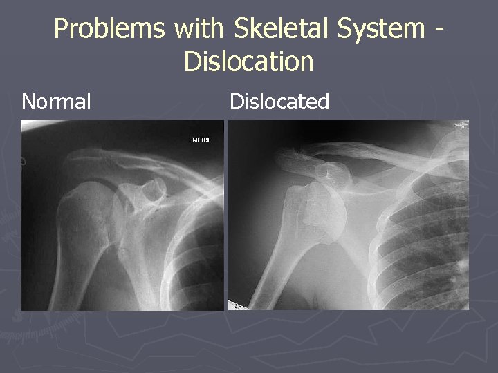 Problems with Skeletal System Dislocation Normal Dislocated 