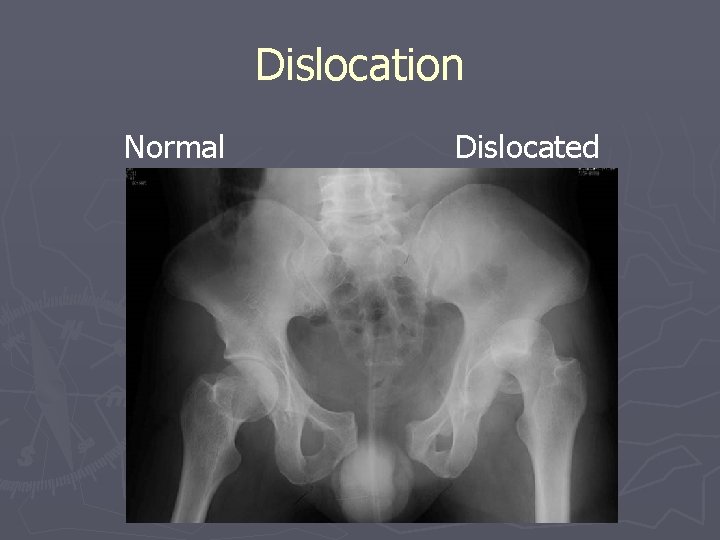 Dislocation Normal Dislocated 